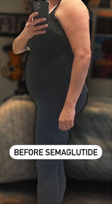 Before Image: Semiglutide - left-side