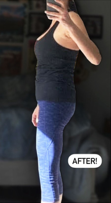 After Image: Semiglutide - left-side